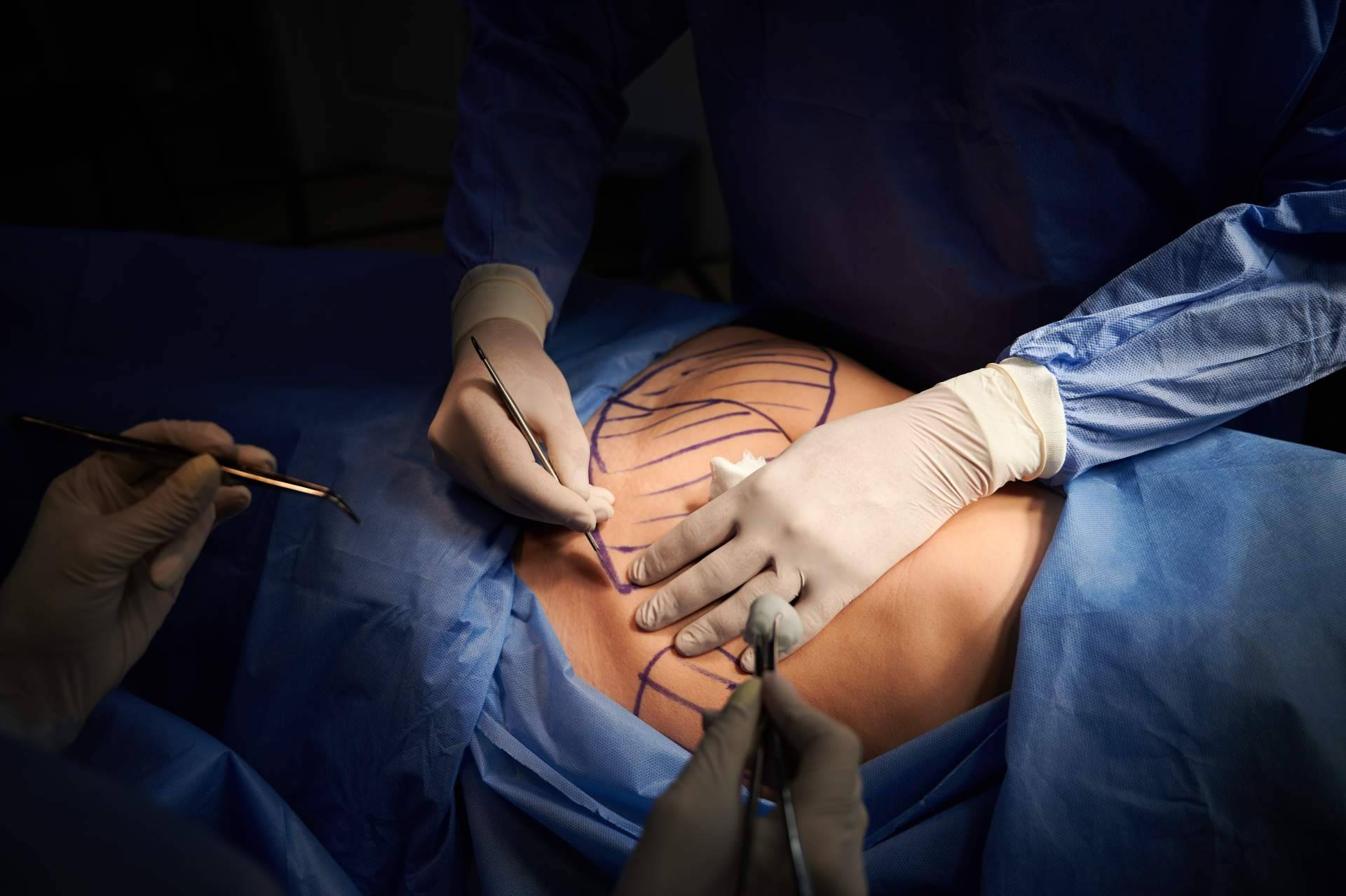¿Qué intervenciones de cirugía plástica contempla el paquete 'todo incluido' del Dr. Guarocuya Almanzar?